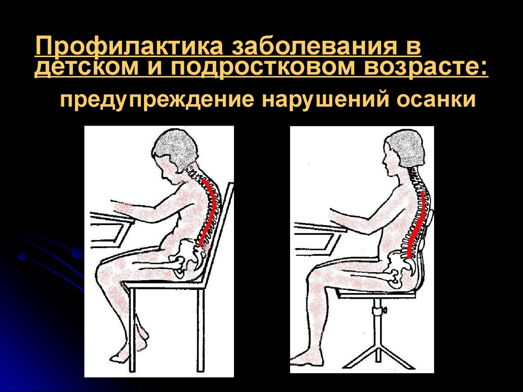 Профилактика остеохондроза позвоночника картинки