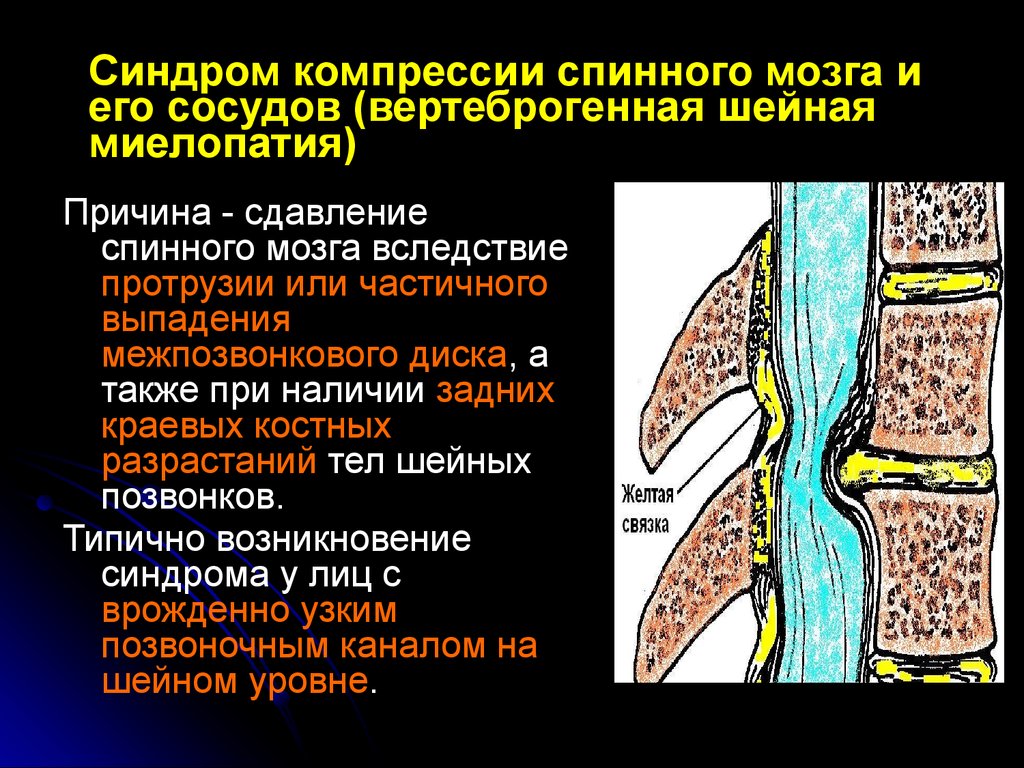 Вертеброгенный генез. Синдромы при сдавлении спинного мозга. Синдром компрессии спинного мозга неврология. Синдром сдавления Корешков спинномозговых нервов. Сдавление Корешков спинного мозга симптомы.