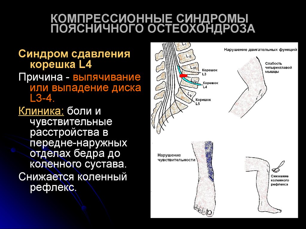 Остеохондроз поясничного. Сдавление корешка l4. Сдавление Корешков l4. Симптомы компрессии Корешков l4. Компрессия корешка l5-s1 клиника.