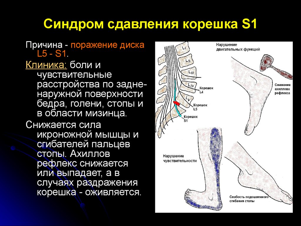 Карта вызова смп остеохондроз поясничного отдела позвоночника корешковый синдром