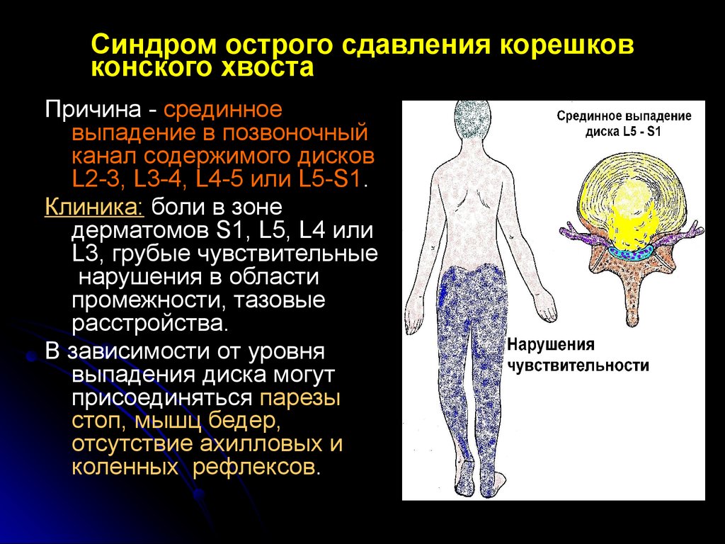 Дорсопатия на фоне остеохондроза позвоночника