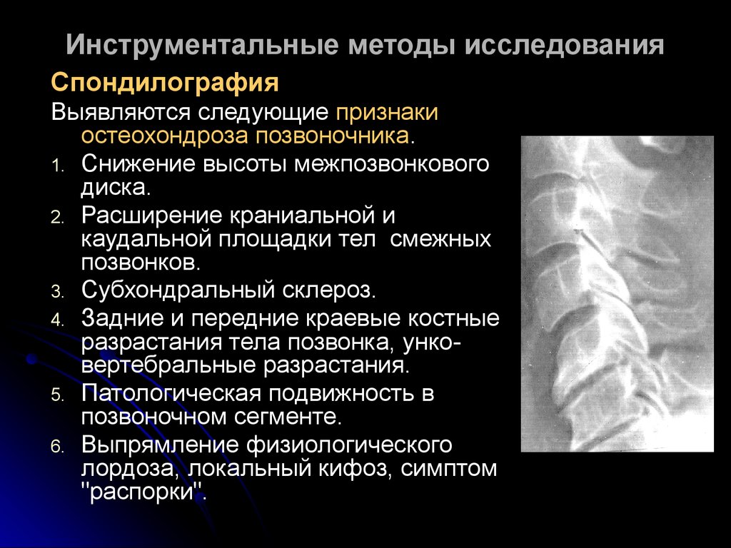 Межпозвоночный склероз. Методы исследования при остеохондрозе. Склероз замыкательных пластинок позвоночника рентген. Остеохондроз методы обследования. Субхондрального склероза позвоночника.