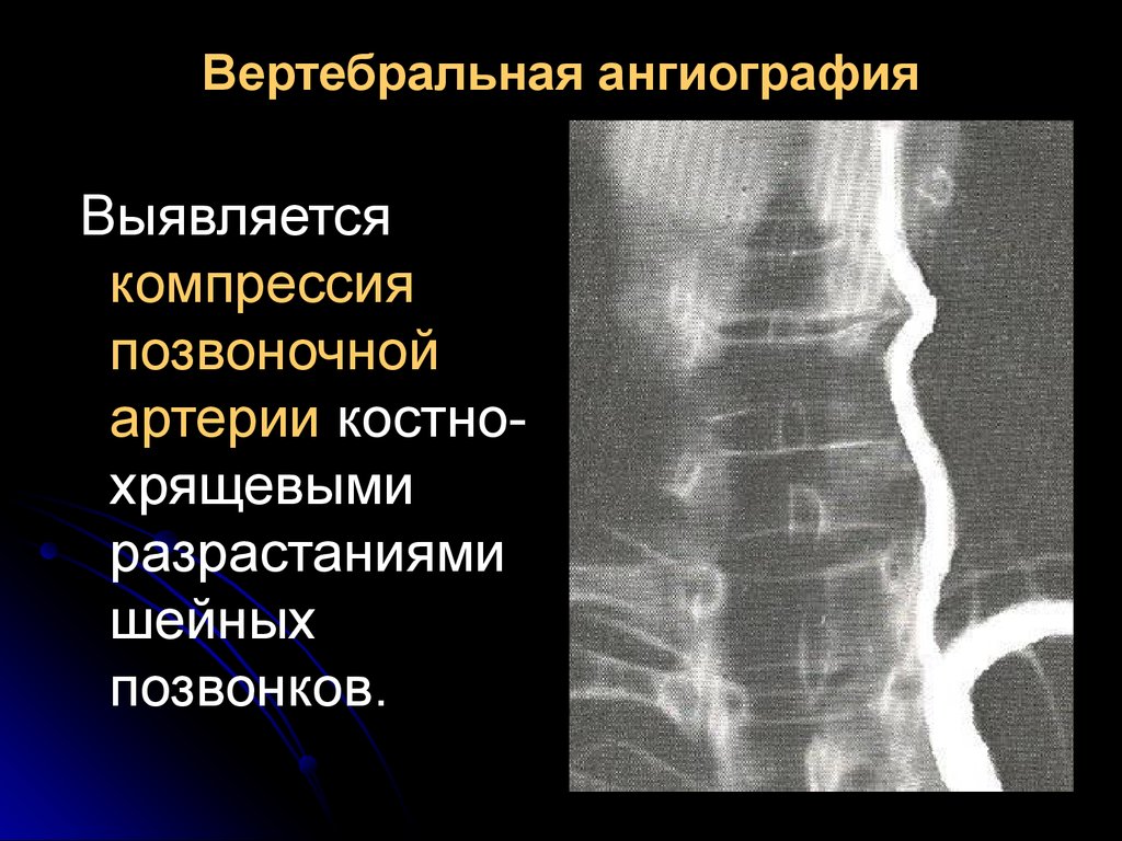 Синдром позвоночника. Синдром позвоночной артерии кт. Ангиография позвоночной артерии. Вертебральная ангиография. Сдавление позвоночной артерии.