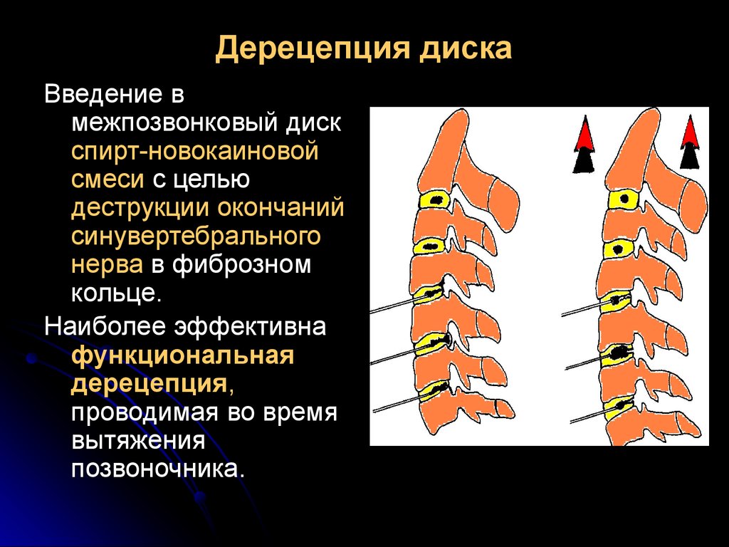 Рчд позвоночника. Химическая дерецепция межпозвонковых дисков. Дерецепция дисков позвоночника. Дерецепция дисков поясничного отдела позвоночника. Что такое дерецепция межпозвонковых дисков.