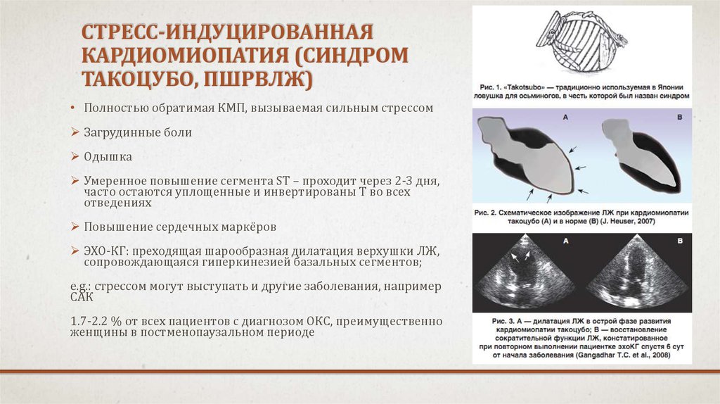 Индуцированный синдром. Диагностические критерии синдрома такоцубо. Синдром такоцубо патогенез. Синдром такоцубо клинические рекомендации.