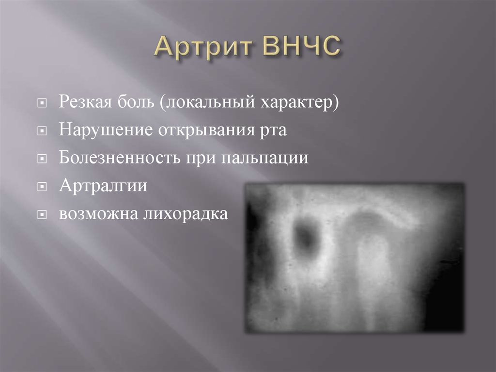 Височно нижнечелюстной сустав симптомы. Острый артрит ВНЧС рентген. Острый травматический артрит ВНЧС. Хронический травматический артрит ВНЧС. Ревматоидный артрит ВНЧС рентген.