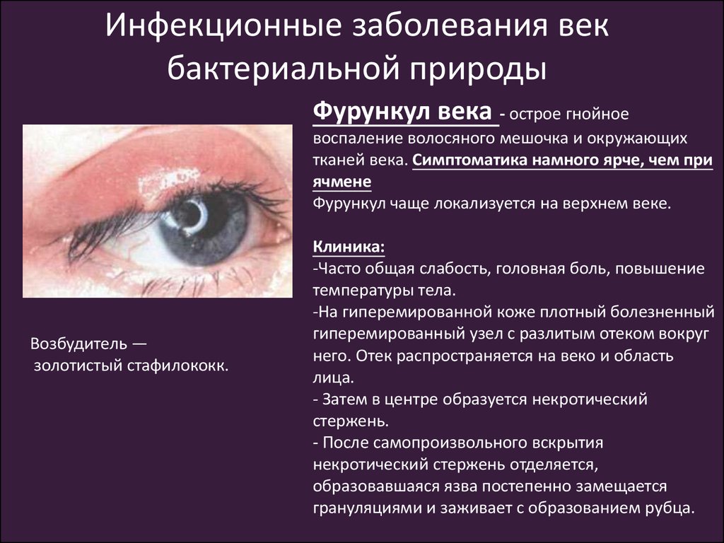 5 заболеваний глаз. Воспалительные заболеванийвек. Инфекционные заболевания век.