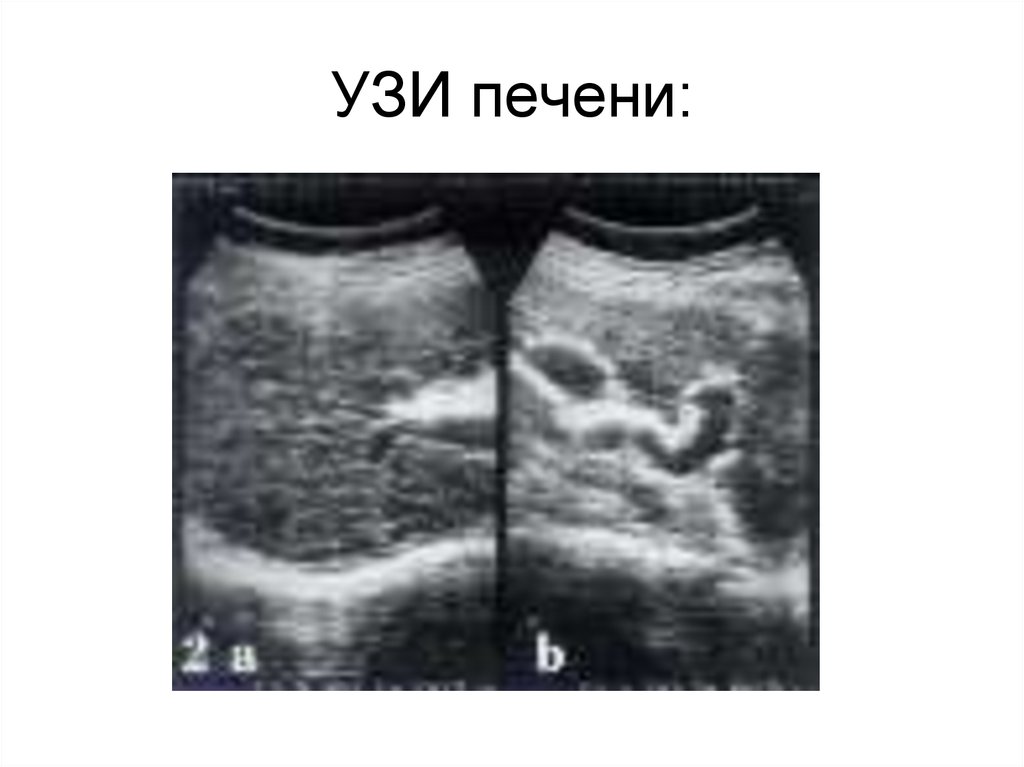 Портальная гипертензия узи картина