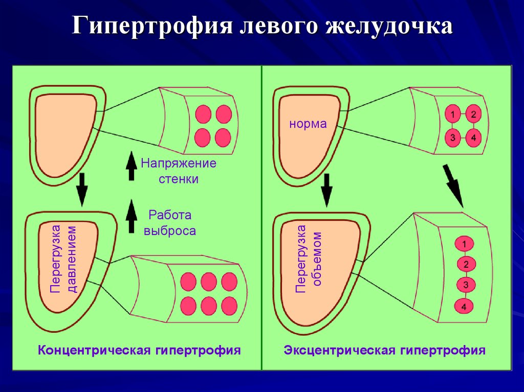 Миокарда левого. Концентрическая гипертрофия миокарда лж. Концентрическая и эксцентрическая гипертрофия. Типы гипертрофии левого желудочка.