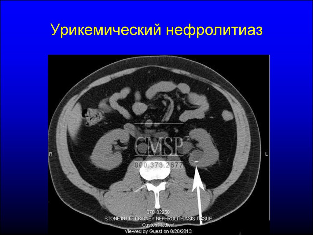 Нефролитиаз это. Подагрическая нефропатия. Почечнокаменная болезнь (нефролитиаз). Подагрическая нефропатия патогенез.