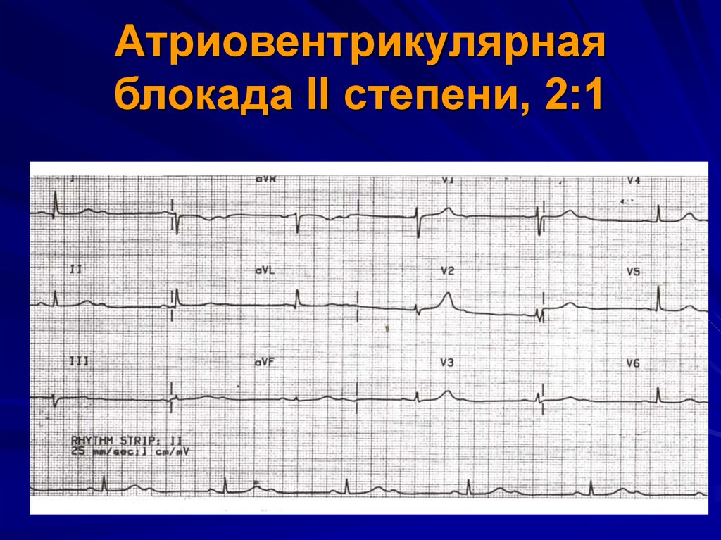 Блокада первой степени. ЭКГ атриовентрикулярная блокада Мобиц 2. Атриовентрикулярная блокада Мобиц 1 ЭКГ. Av блокада 2 степени 3 ти. АВ блокада 2 степени Мобиц 1 на ЭКГ.