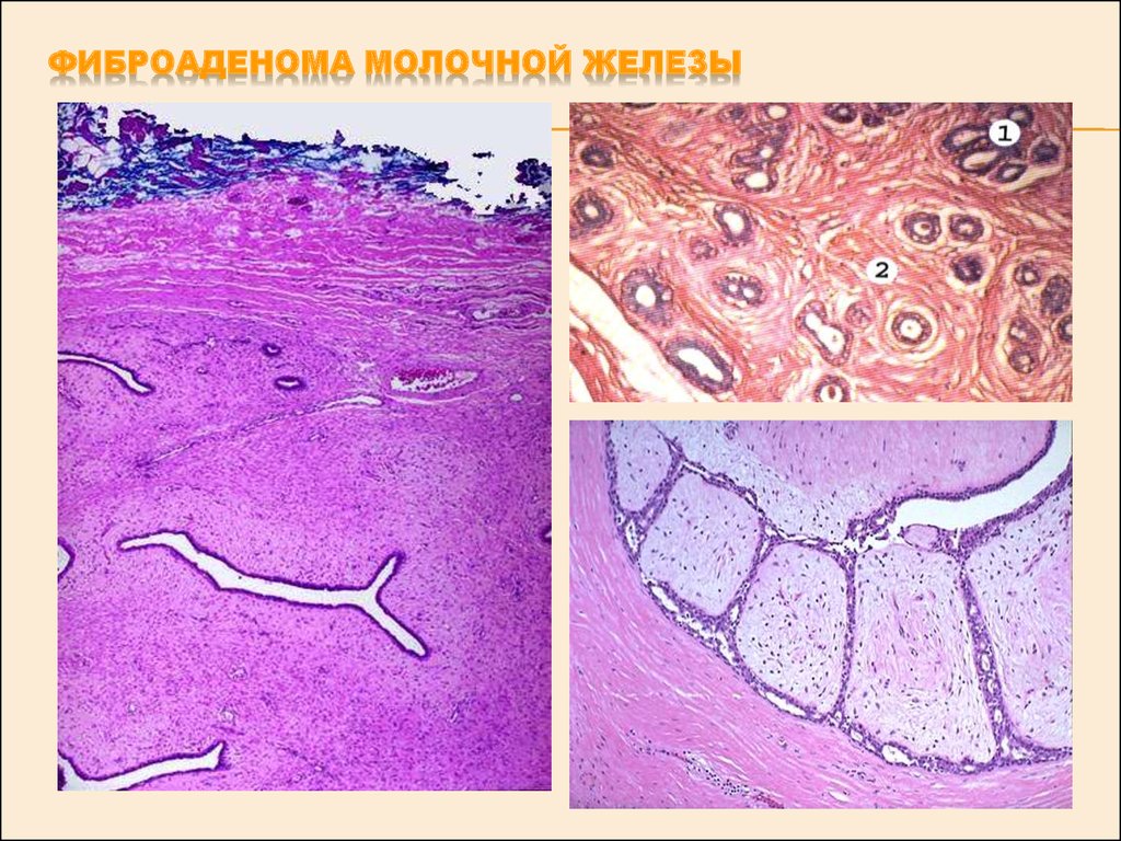 Фиброаденома молочной. Интраканаликулярная фиброаденома молочной железы микропрепарат. Интраканаликулярная фиброаденома молочной железы гистология. Фиброаденома молочной железы микроскопия. Фиброаденома молочной же.