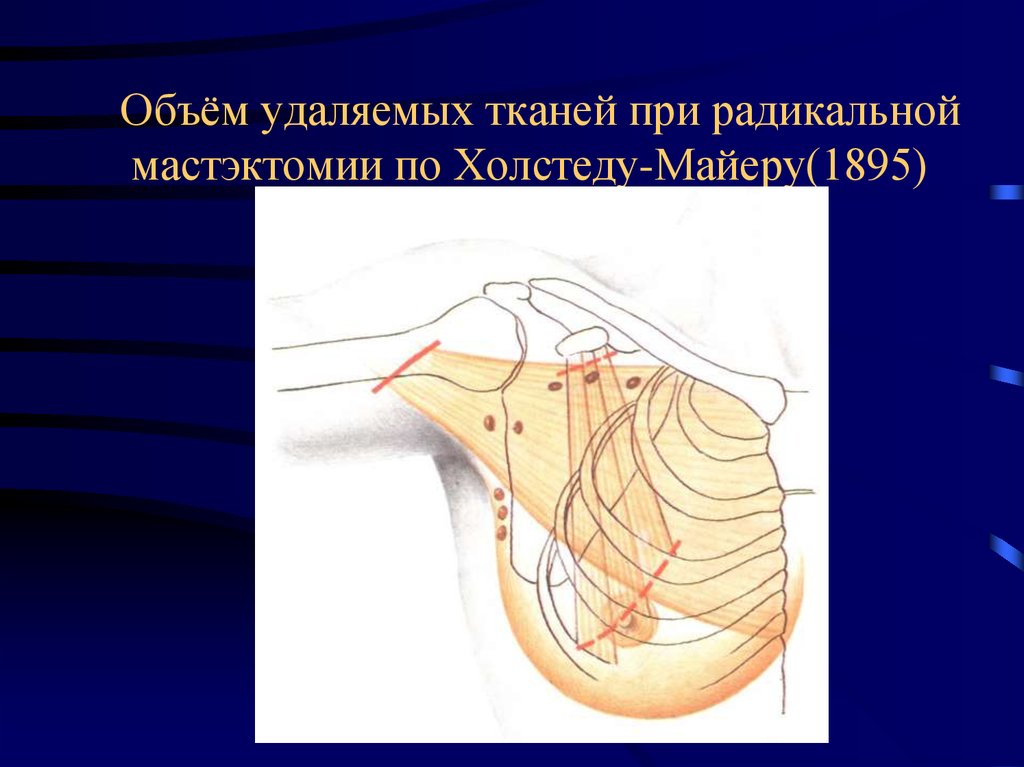 Мастэктомия. • Радикальная мастэктомия по Halsted Mayer. Радикальной мастэктомии по Холстеду-Майеру. Мастэктомия по пейти Дайсону.