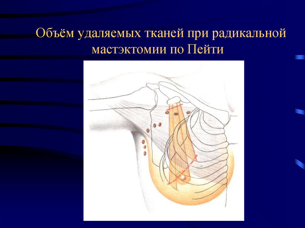 Мастэктомия по холстеду. Радикальной мастэктомии по Холстеду-Майеру. Мастэктомия по пейти Дайсону. Модифицированная радикальная мастэктомия по пейти. Радикальная мастэктомия по пейти-Дайсону это.