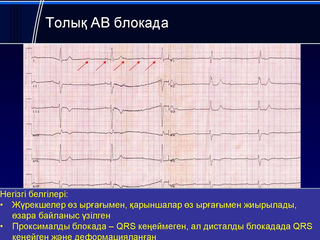 Блокады на экг расшифровка фото и обозначения