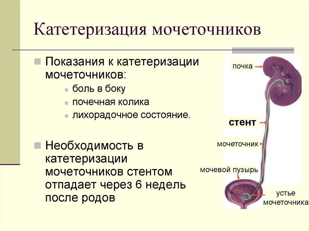 После пластики мочеточника