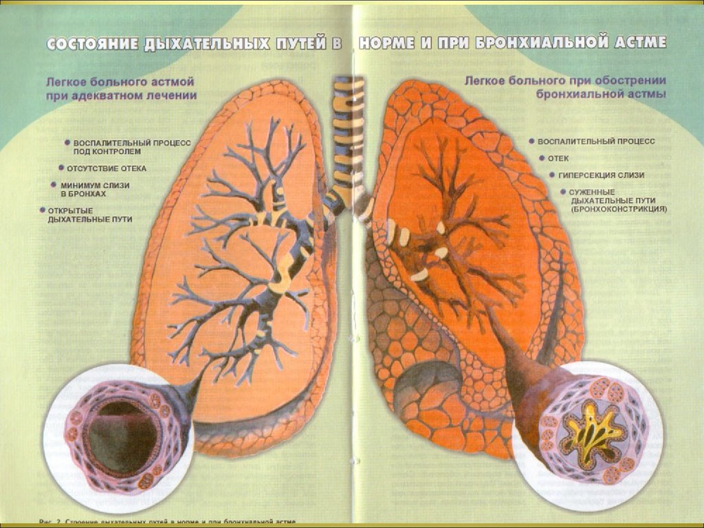 Бронх астма. Бронхиальная астма бронхи. Бронхиальная астма легкие. Лёгкие при бронхиальной астме. Изменение бронхов при бронхиальной астме.