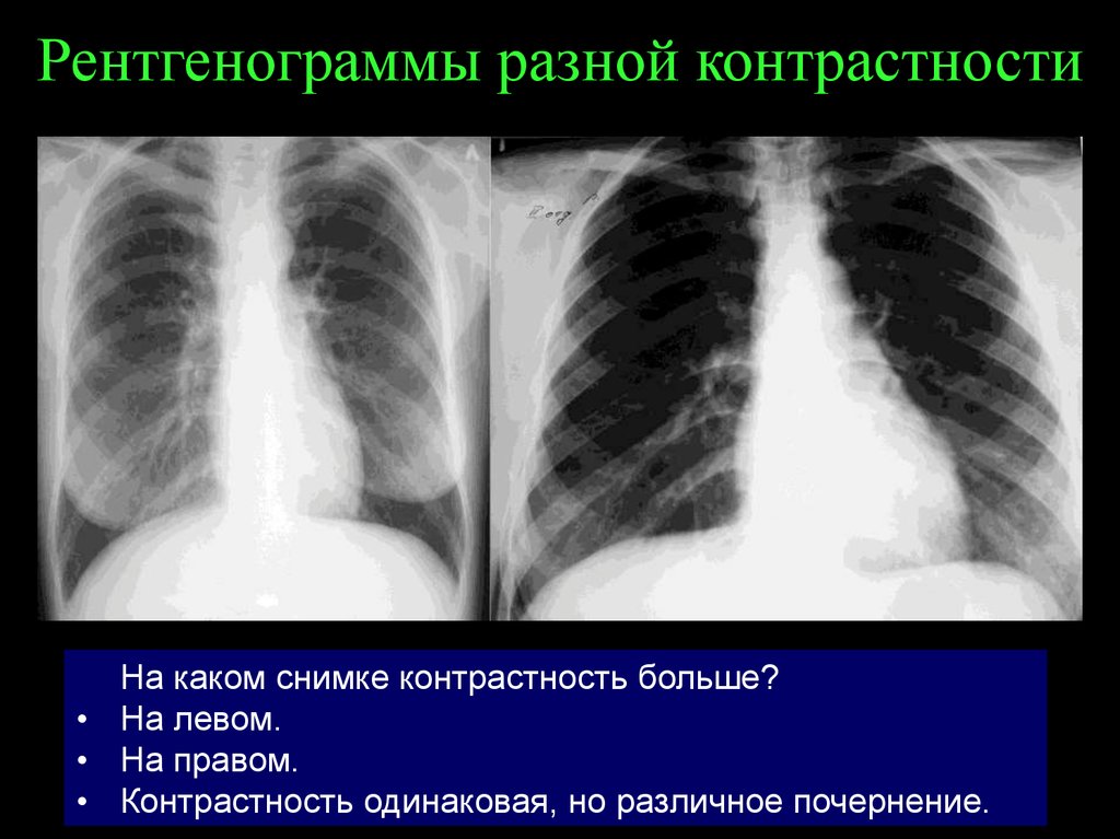 Контраст между деталями рентгеновского изображения главным образом обусловлен