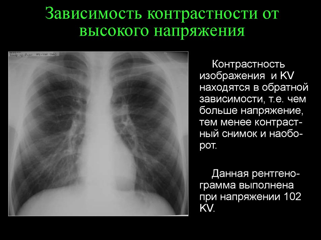 Контрастность. От чего зависит контрастность рентгеновского снимка. От чего зависит контрастность рентгенограммы. Как увеличить контрастность рентгеновского снимка. Как определить контрастность рентгеновского изображения.