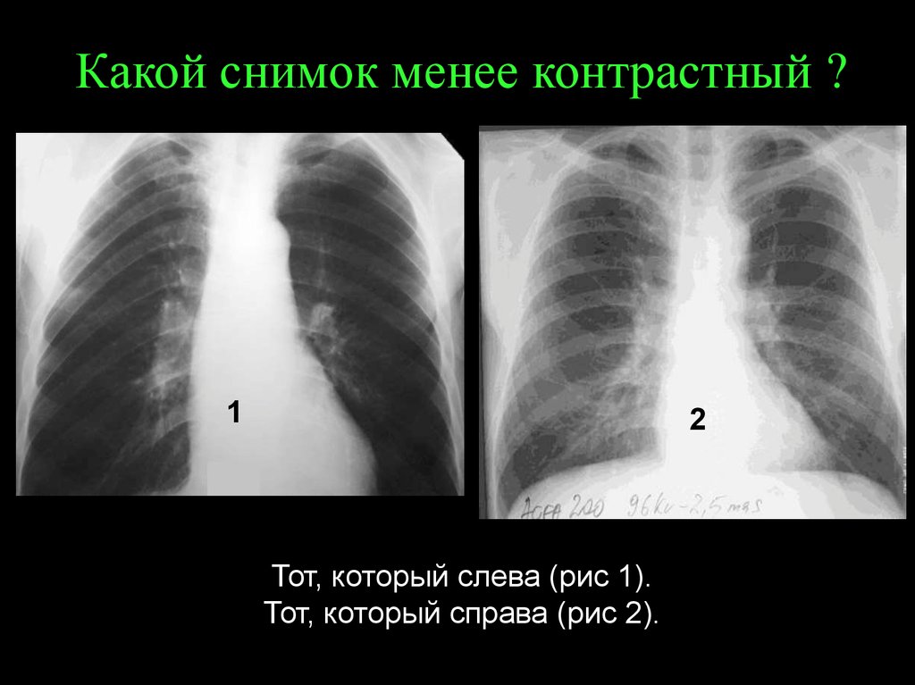 Какой снимок нужен. Контрастность рентгенограммы. Рентгеновские снимки с низкой контрастностью. Какой снимок считается резким.