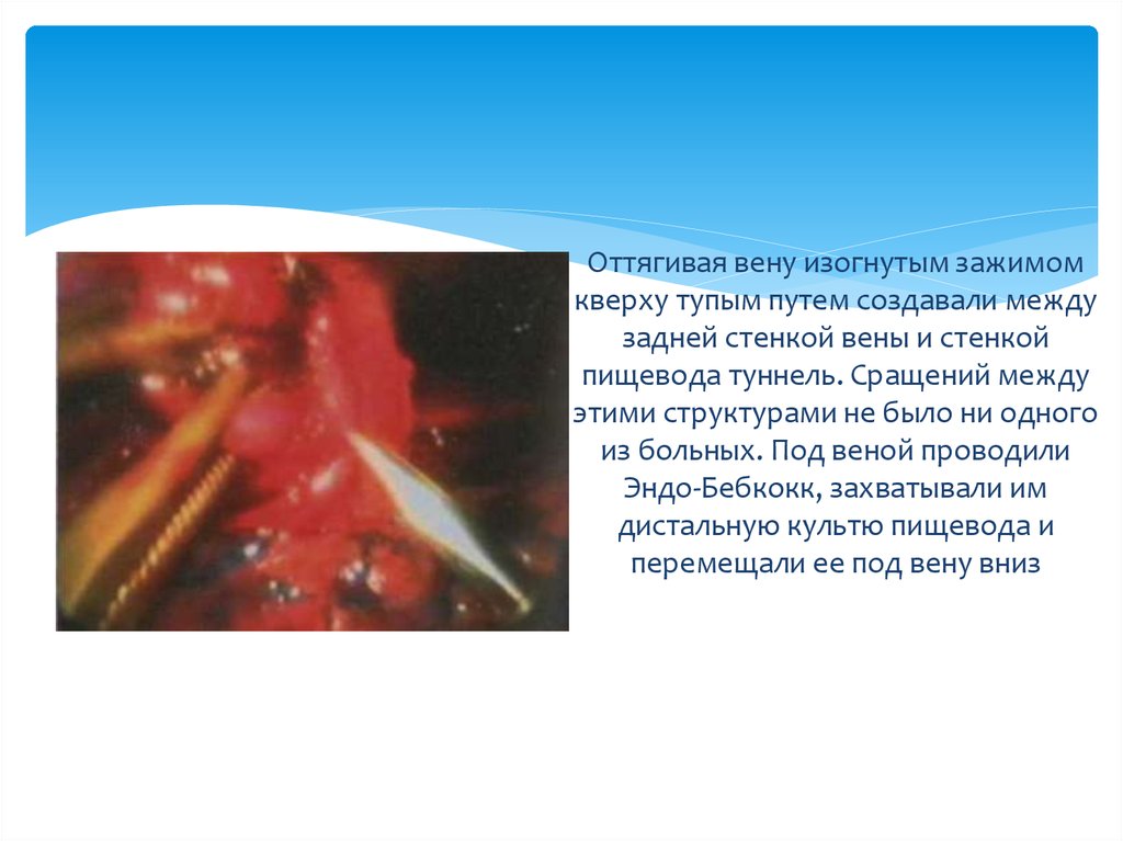 Оттягивая вену изогнутым зажимом кверху тупым путем создавали между задней стенкой вены и стенкой пищевода туннель. Сращений между этими 