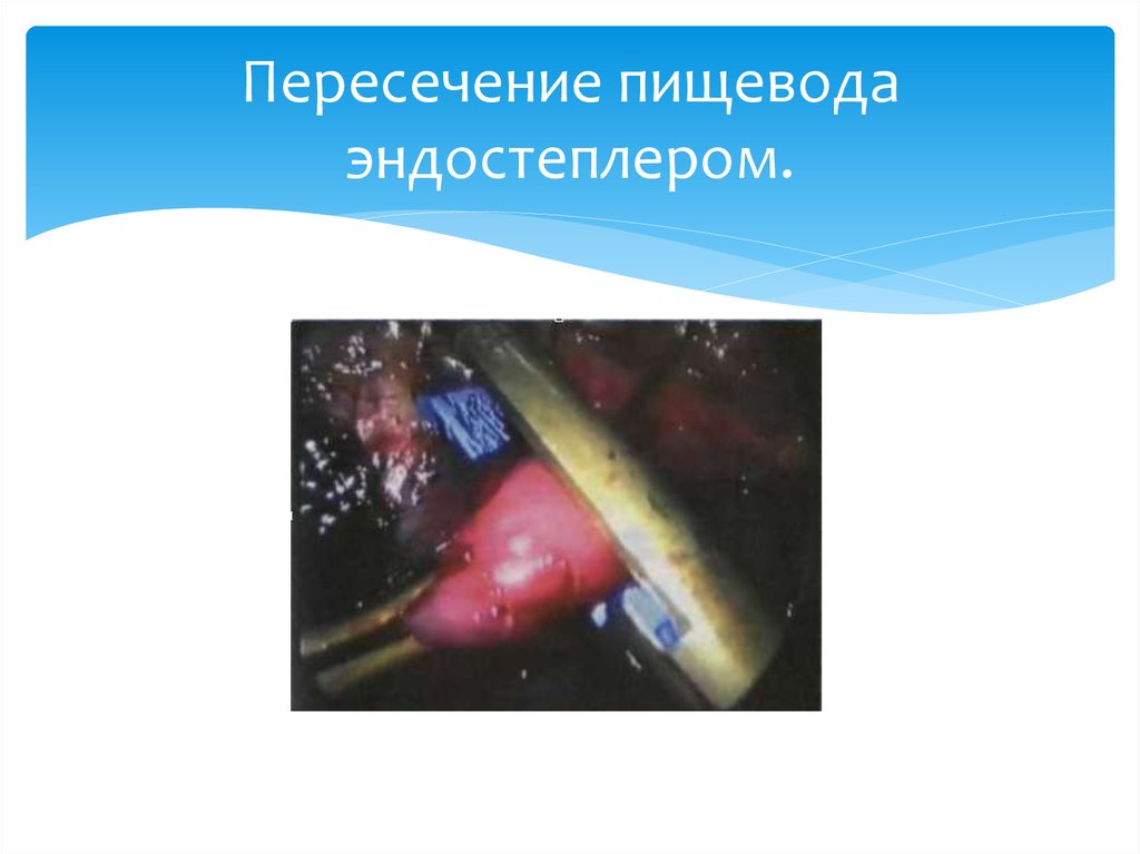 Пересечение пищевода эндостеплером.