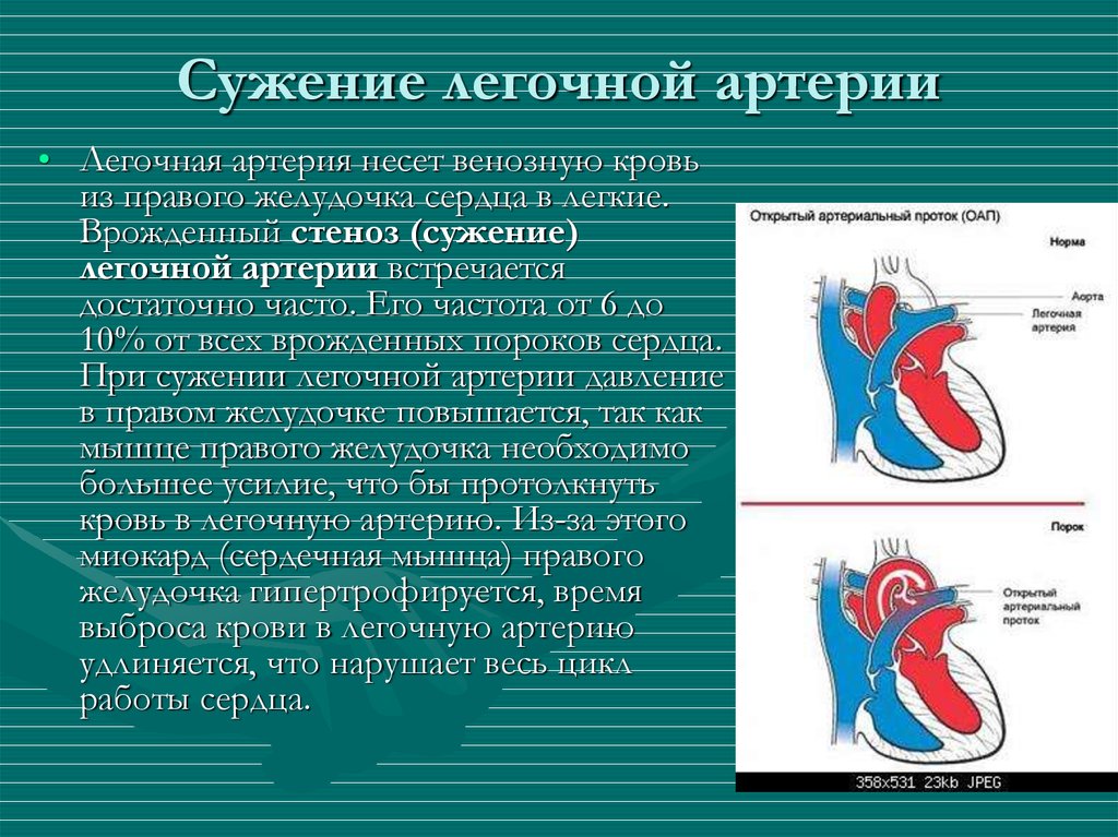 Что такое стеноз. Изолированный клапанный стеноз легочной артерии. ВПС изолированный стеноз легочной артерии. Стеноз клапана легочной артерии схема. Изолированный стеноз легочной артерии этиология.