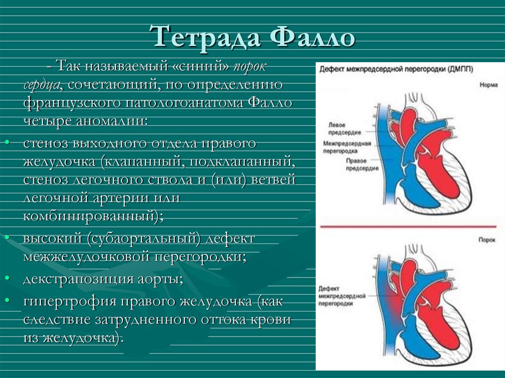 Тетрада фалло клиническая картина