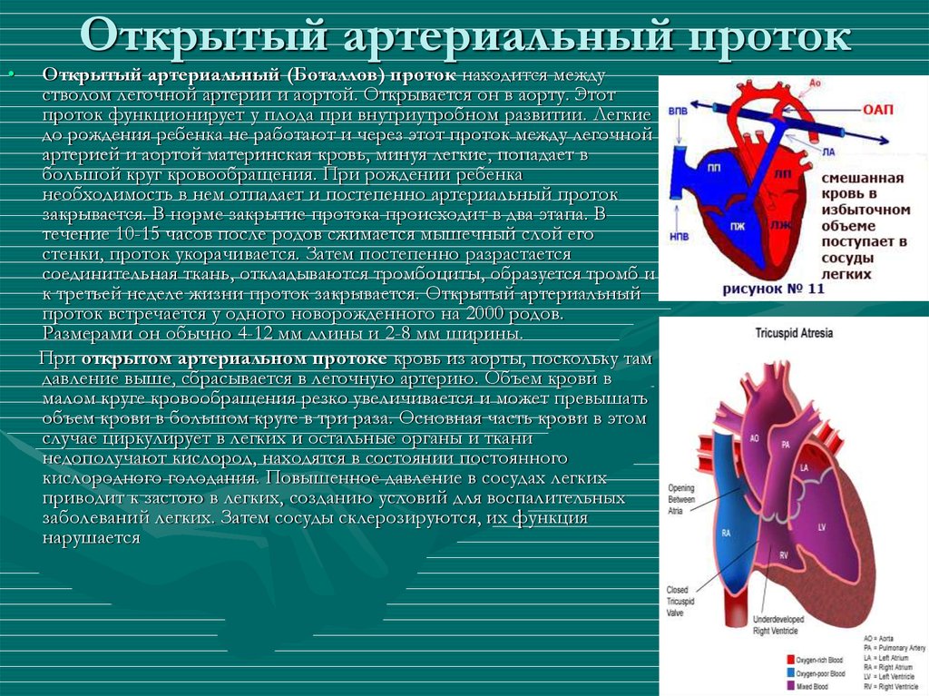 Открытый артериальный проток у детей