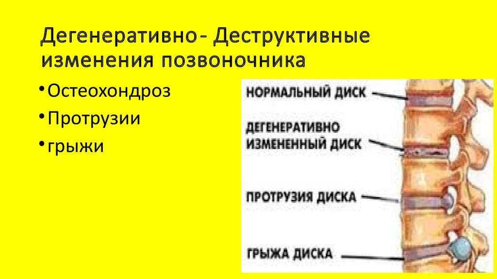 Начальное дегенеративные изменения шейного отдела. Дегенерация межпозвоночного диска поясничного отдела. Дегенеративные изменения грудного позвоночника. Дегенеративные изменения дисков грудного отдела позвоночника. Деструктивно дегенеративные изменения позвоночника.