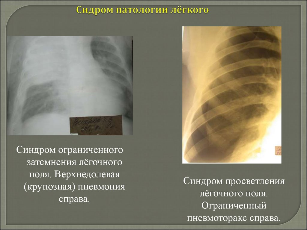 Просветление в легких. Синдром ограниченного затемнения рентген. Синдром затемнения легочного поля рентген. Крупозная пневмония рентген затемнение. Рентгенологический синдром крупозной пневмонии.