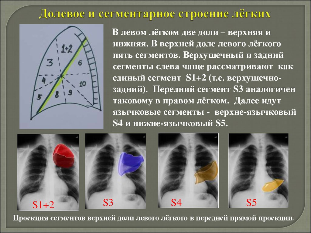 Пневмония верхней доли легкого. Сегменты легкого на рентгенограмме s1 s2 s3. Сегменты s1 s2 правого легкого. Язычковые сегменты левого легкого рентген. Сегмент 5 верхней доли левого легкого.