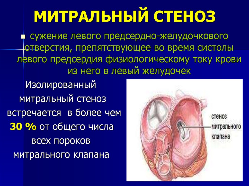 Поражение митрального клапана. Пороки сердца стенозы клапанов. Пороки сердца стенозы клапанов недостаточность клапанов. Приобретённые пороки сердца недостаточность митрального клапана. Пороки сердца стеноз митрального клапана.