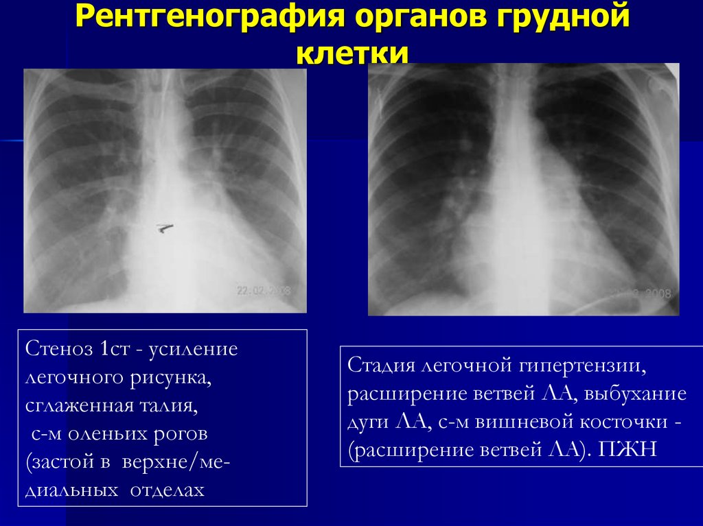 Легочный рисунок в базальных отделах. Усиление легочного рисунка. Усиление легочного рисунка на рентгене. Тяжистый легочный рисунок. Рентгенография органов грудной клетки.