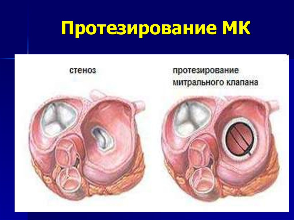 Митральный клапан после операции. Протез митрального клапана сердца. Протез клапана сердца митральный клапан. Осложнения протезирования митрального клапана. Протезирование митрального клапана операция.