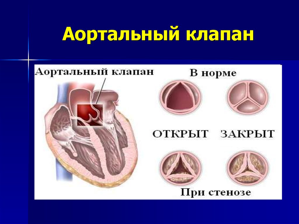 Пороки аортального клапана презентация