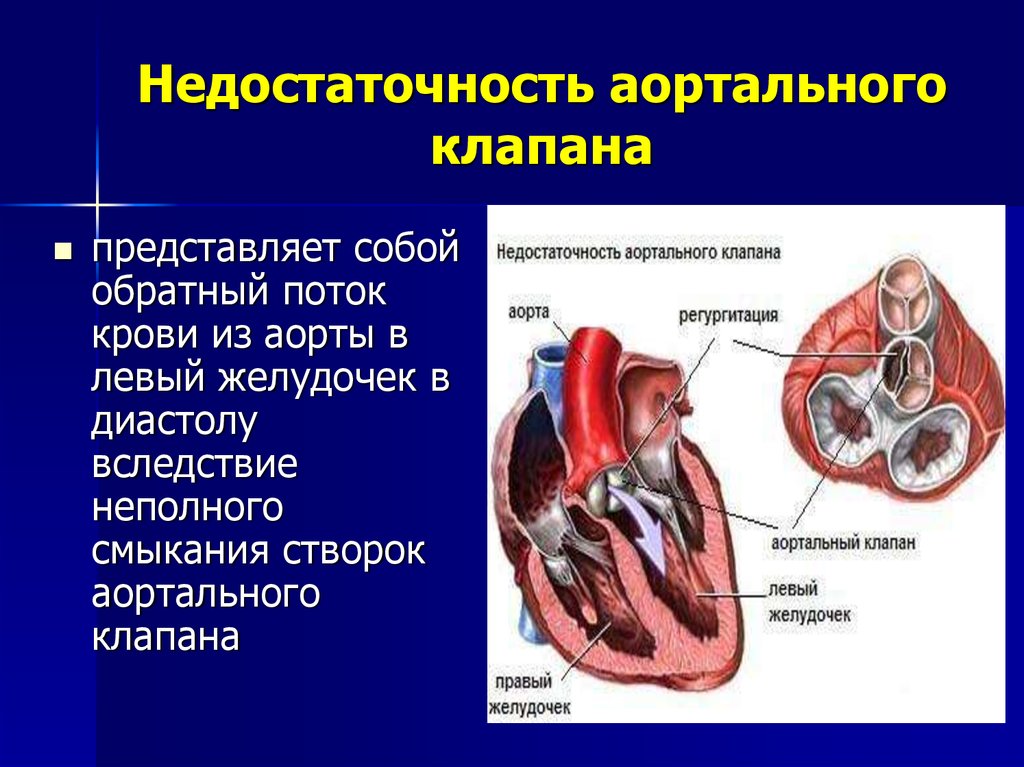 Трикуспидальная недостаточность презентация