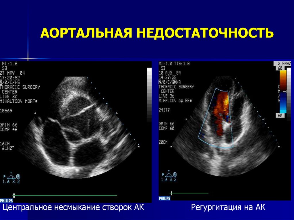 Аортальная недостаточность презентация