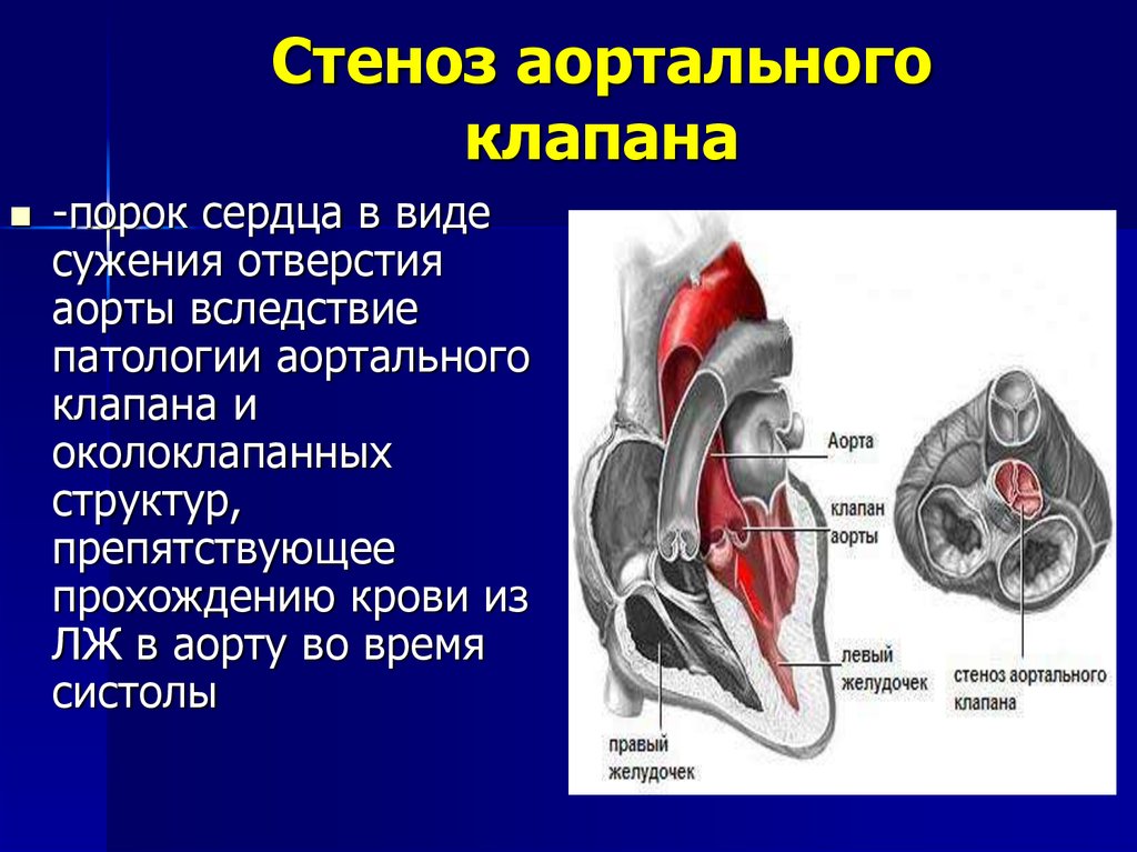 Стеноз что это. Порок аортального клапана сердца. Порок сердца стеноз аортального клапана. Стеноз митрального клапана стеноз аортального клапана. Стеноз и недостаточность аортального клапана.