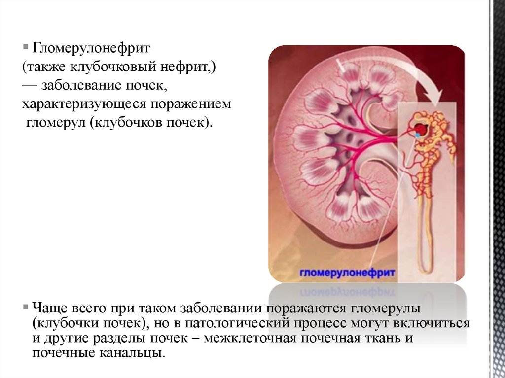 Презентация на тему гломерулонефрит