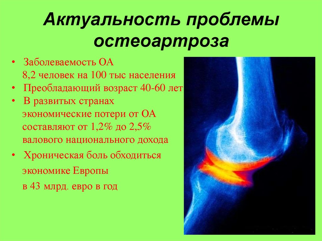 Актуальность проблемы остеоартроза