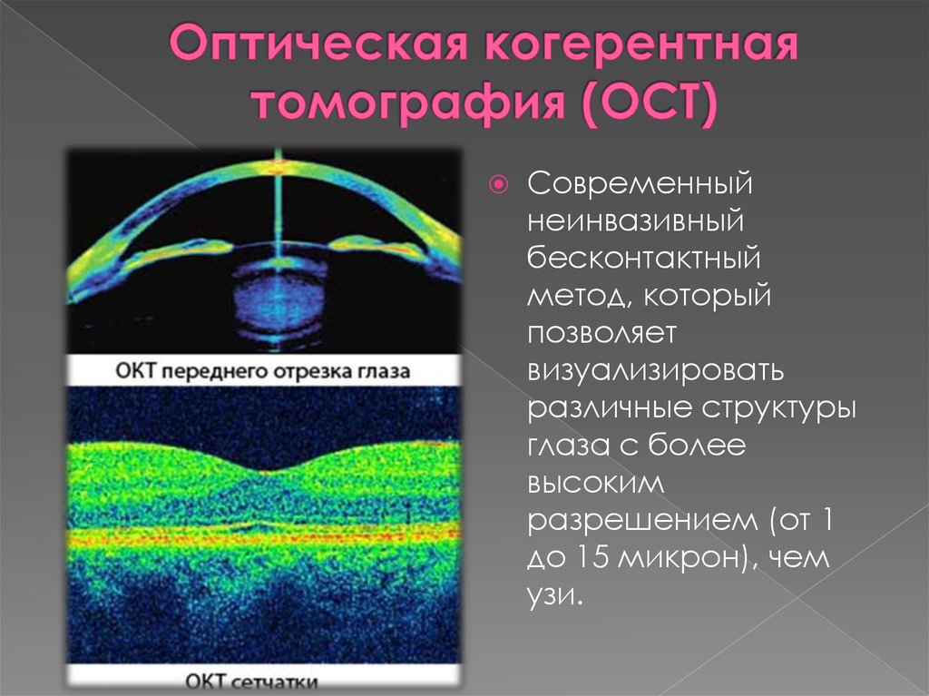 Окт. Спектральная оптическая когерентная томография. Оптическая когерентная томография (окт) заднего отрезка. Оптическая когерентная томография глаза. Когерентная томография сетчатки.