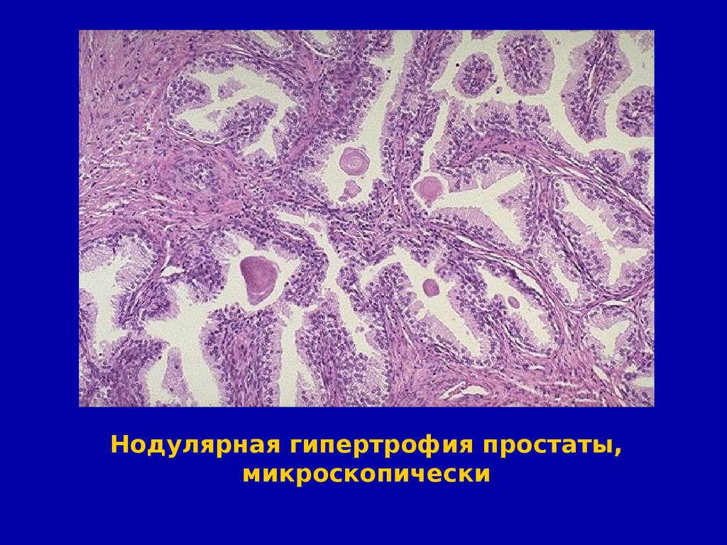 Железистая гиперплазия предстательной железы. Железистая гипертрофия предстательной железы микропрепарат. Гиперплазия простаты гистология. Аденома предстательной железы гистология. Гипертрофия предстательной железы микропрепарат.