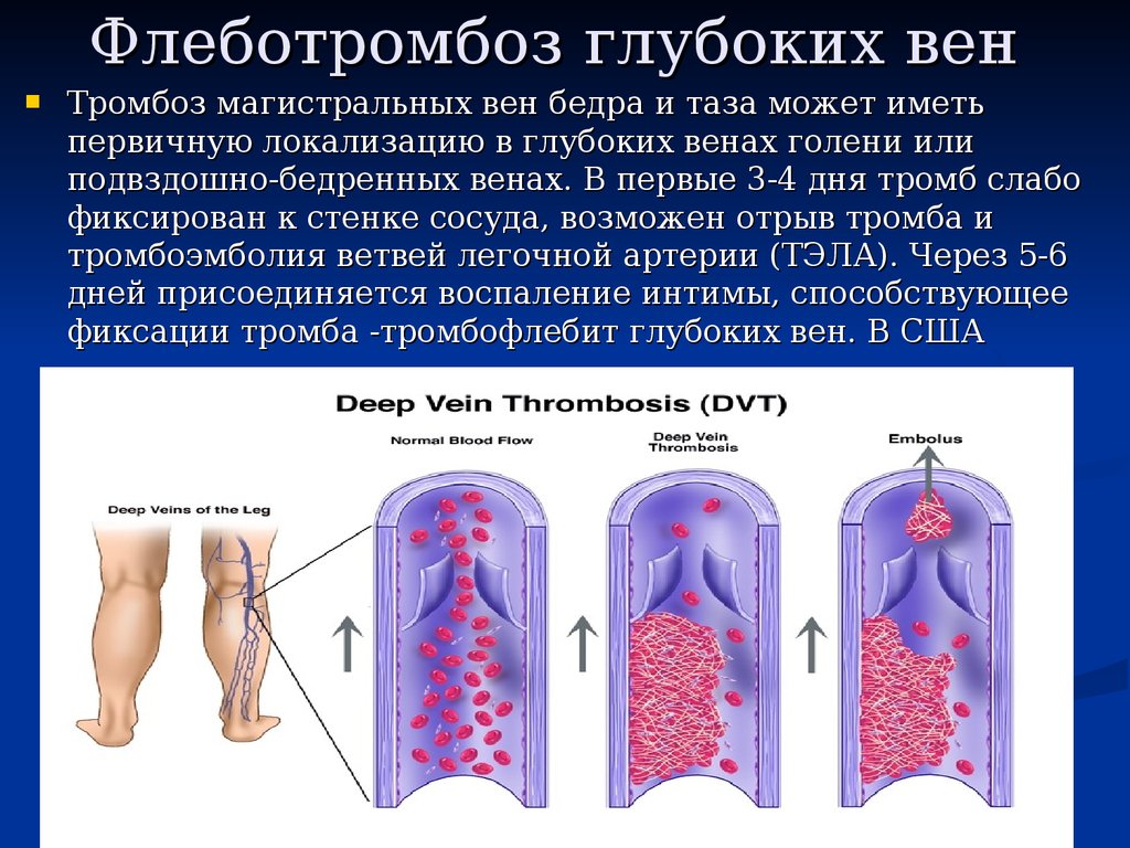 Признаки глубокого тромбоза