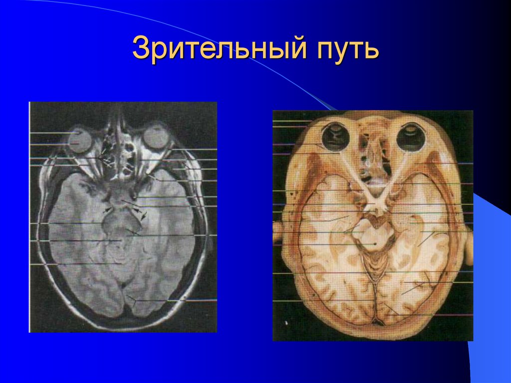 Зрительный путь. Путь зрительной информации начинается. Болезни зрительных путей. Путь зрительных ощущений.