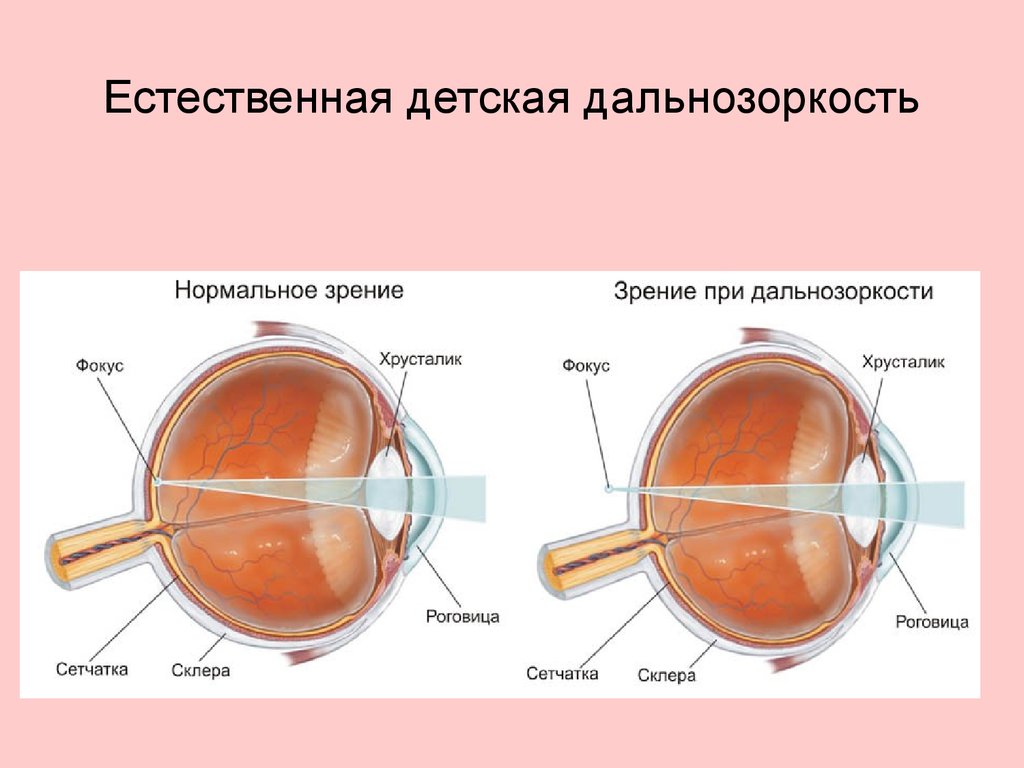 Слабая миопия глаза что. Миопия гиперметропия астигматизм. Гиперметропия 2 степени у детей 2 года. Строение глаза астигматизм. Дальнозоркость 8 диоптрий.
