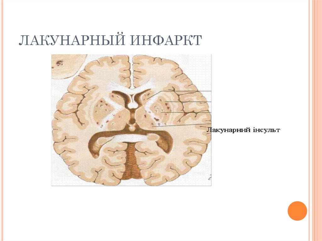 Головное мозг инвалидность. Лакунарный ишемический инфаркт. Лакунарный ишемический инсульт. Лакунарный инфаркт мозга. Лакунарный Подтип ишемического инсульта.