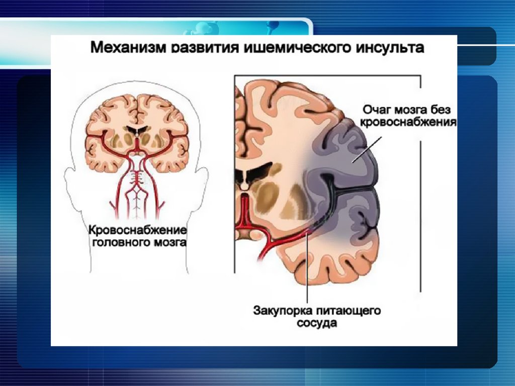 План сестринского вмешательства при геморрагическом инсульте