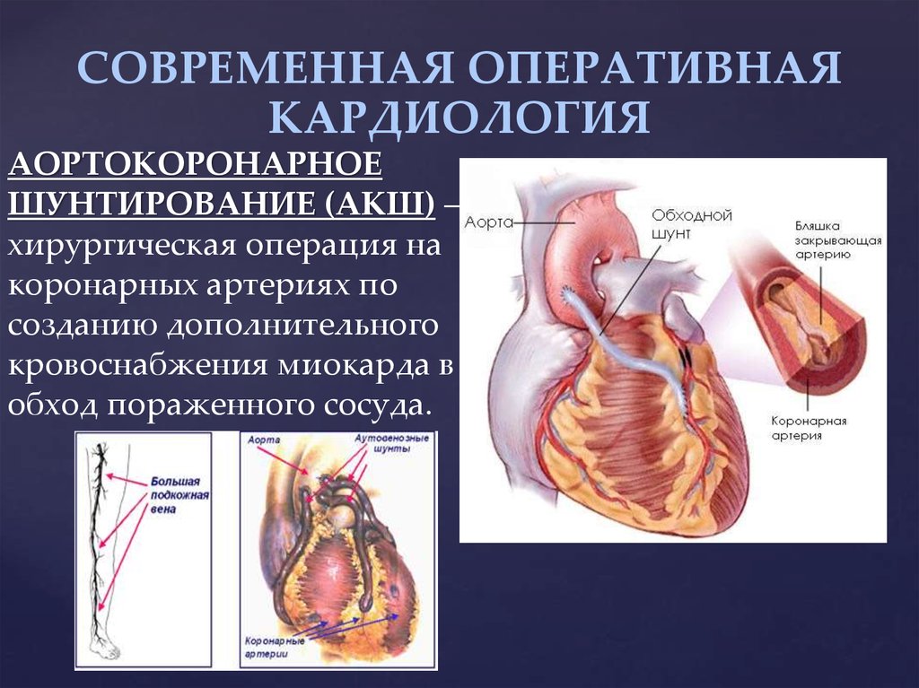 Шунт в медицине. Операция Колесова маммарно коронарное шунтирование. Аортокоронарное шунтирование клинические рекомендации. Схема операции аортокоронарного шунтирования. Коронарное шунтирование сосудов сердца.