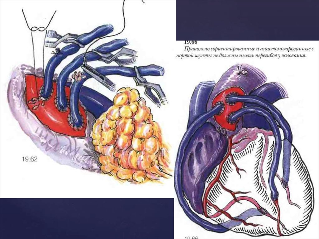 Что такое шунтирование сердца и сосудов. Маммарокоронарное шунтирование (МКШ). Маммарокоронарный анастомоз.